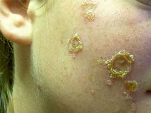 Impetigo contagiosa. (Schmutzflechte) Hat nichts mit Sauberkeit zu tun