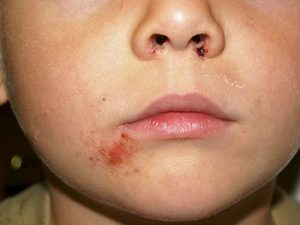 Impetigo contagiosa. Typischerweise im Gesicht eines Kindes