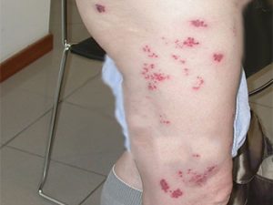 Gürtelrose. Herpes Zoster entlang eines Dermatoms.