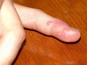 Fieberblasen -Herpes simplex am Finger