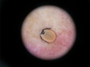 Die Zecke – häufigste Überträger der Borreliose - steckt mit ihrem Kauwerkzeug in der Haut. Dermatoskopisches Bild