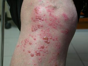 Gürtelrose. Herpes Zoster. Auszug/Nahaufnahme.