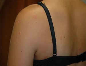 tinea-corporis-hier-uebertragen-von-einem-hund